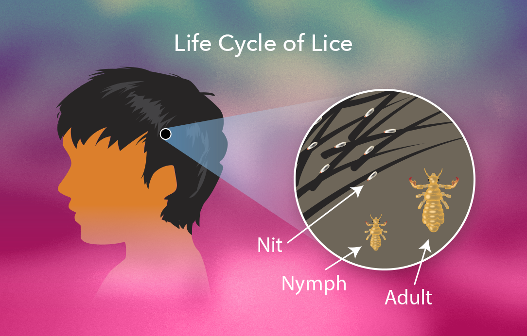 Get Rid of Head Lice My Doctor Online